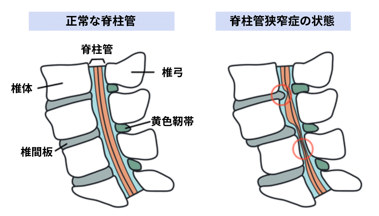 脊柱管狭窄症の図解